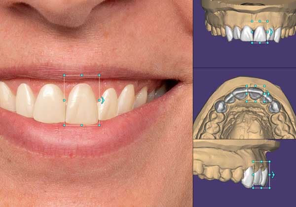 Planificación digital para diseño de sonrisa