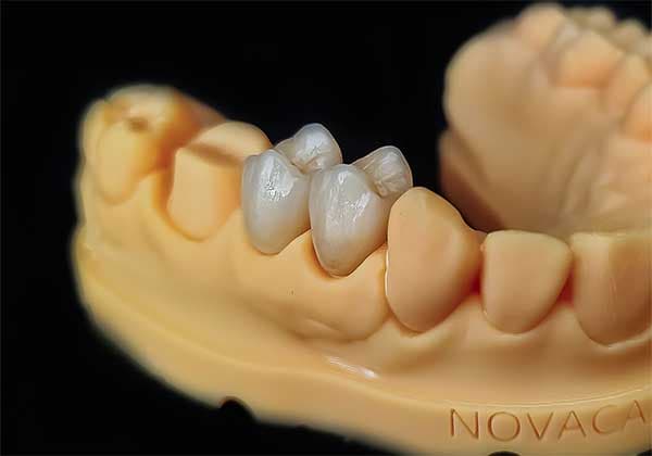 Restauración dental E-Max