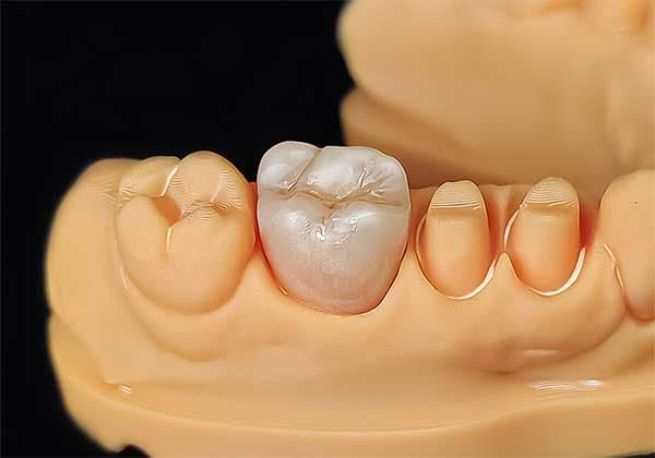 Prótesis provisional dental de PMMA
