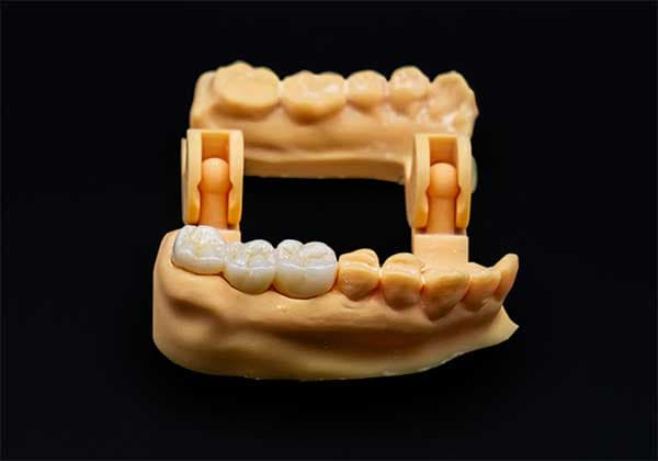 Prótesis dental de zirconia
